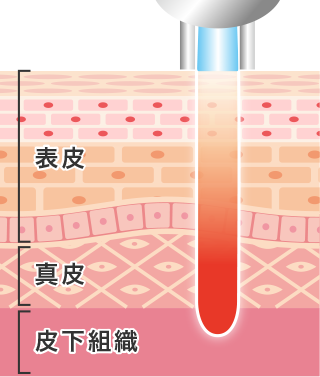 炭酸ガスレーザーの作用